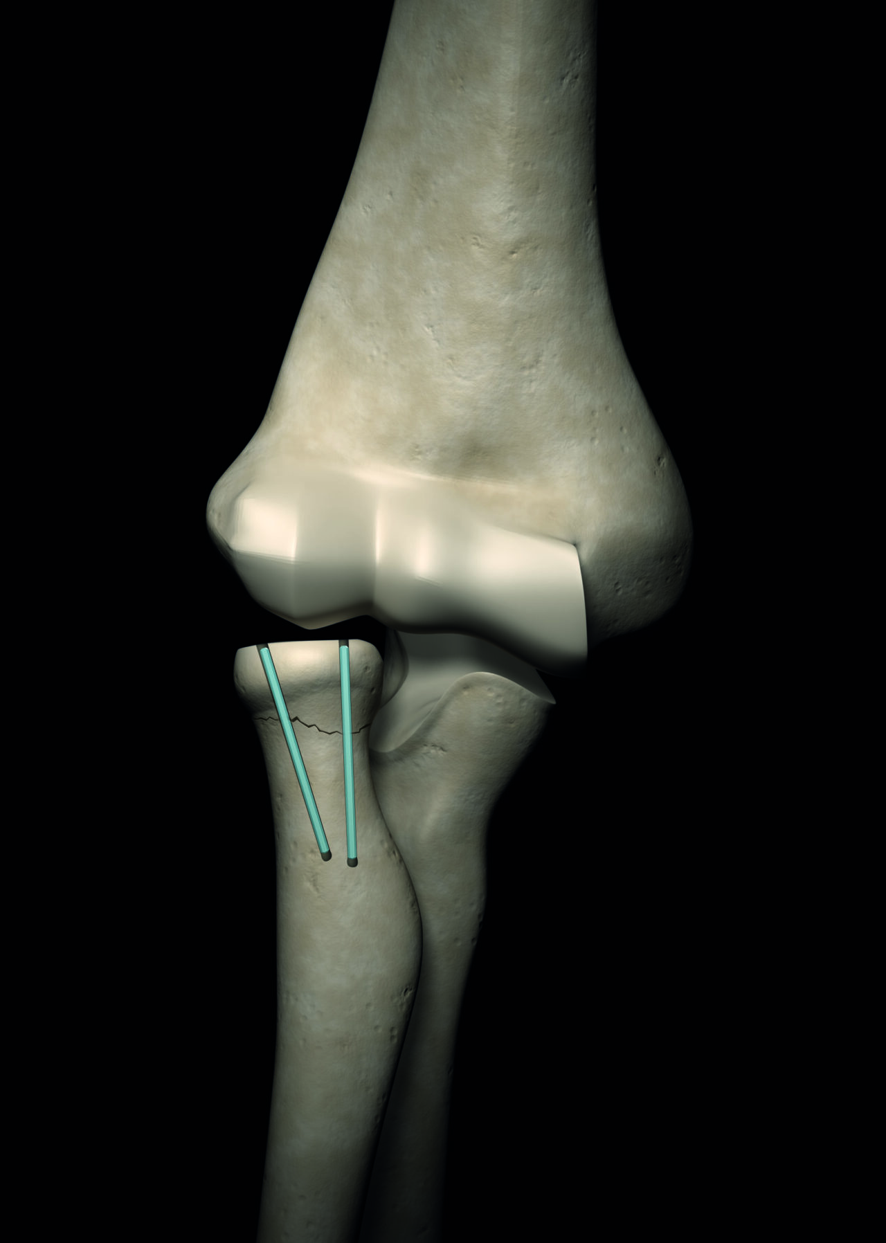 INION FreedomPin™ | Bricon